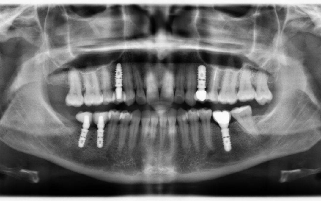 Impianti dentali / Implantologia Innovativa
